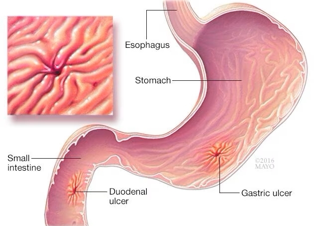 gastrointestinal diseases caused by H. pylori infection