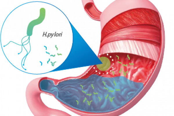 Helicobacter pylori